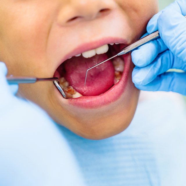 «Лечите желудок и сопли». Стоматолог — о неочевидных причинах кариеса у детей