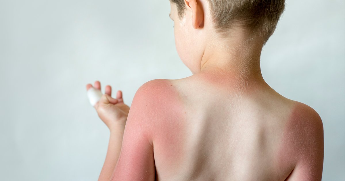 Ребёнок обгорел на солнце: как ему помочь и нужна ли сметана | Мел