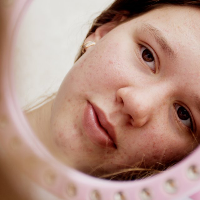 «Просто не трогай лицо!» 5 мифов о проблемной коже у подростков