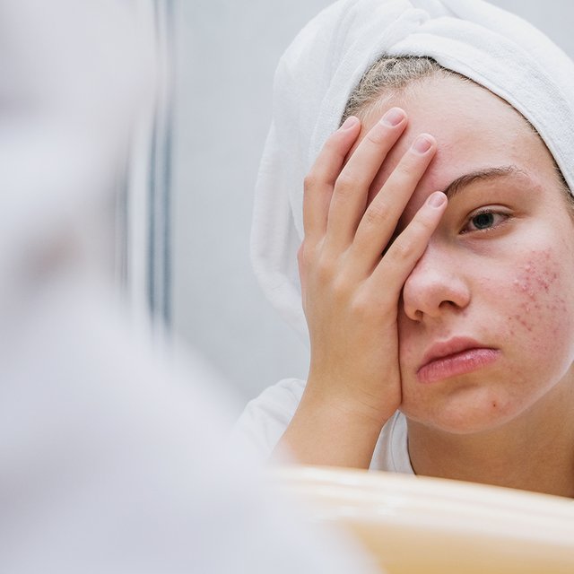 Ребенок комплексует из-за прыщей: как ему помочь?