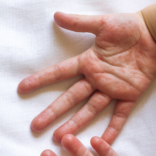 У ребёнка шелушатся ладони: о чём это может говорить и как справиться с сухостью