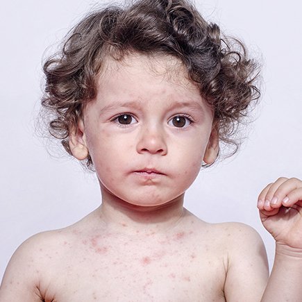 Как понять, что у ребёнка корь?