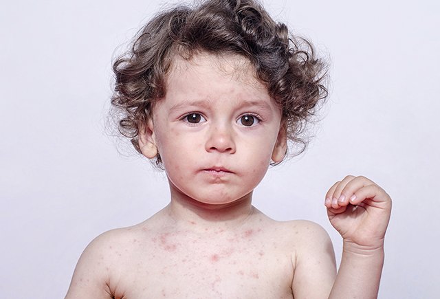 Как понять, что у ребёнка корь?