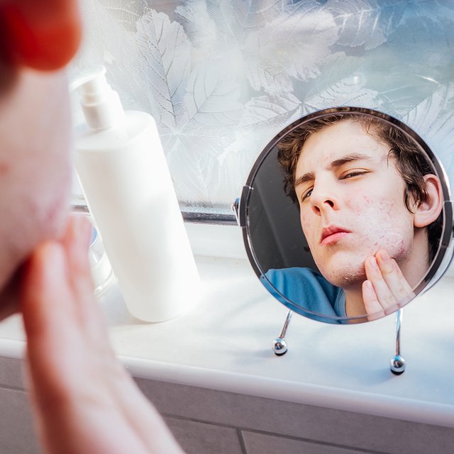 У подростка появились прыщи: как помочь ему с ними справиться