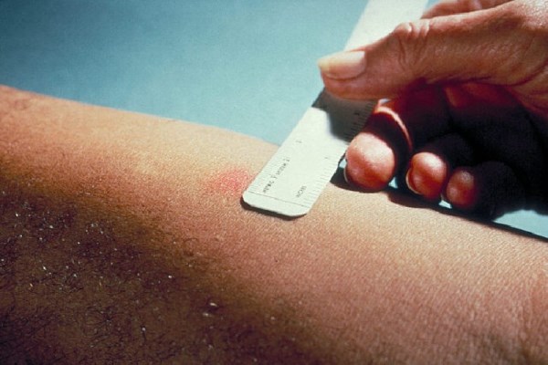 Как выглядит манту при туберкулезе у ребенка Для диагностики туберкулёза у детей кроме пробы Манту теперь будут применять диа