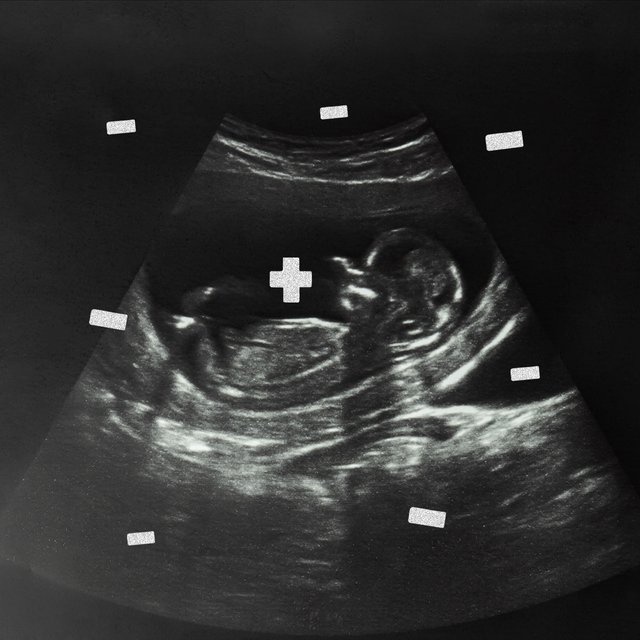 «Всегда виноваты врачи». Акушер-гинеколог, спасший более 1000 детей, — о резус-конфликтных беременностях