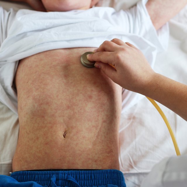 Вспышка кори в России: кто уже болеет и как обезопасить детей и себя