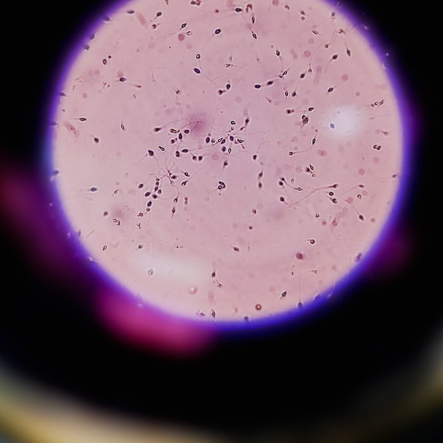 У мужа тератозооспермия. Значит ли это, что он бесплоден?