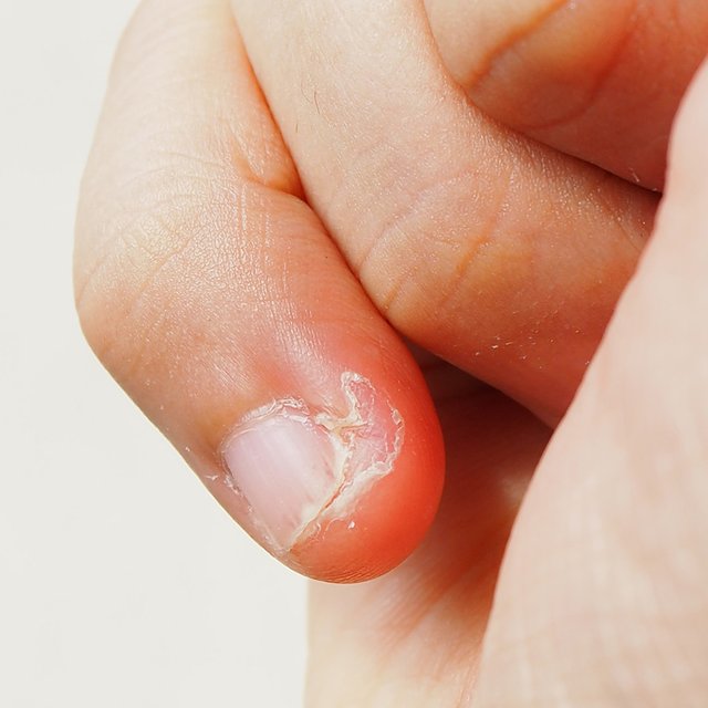 Ребёнок обгрызает ногти и заусенцы до крови: почему он это делает и как его отучить