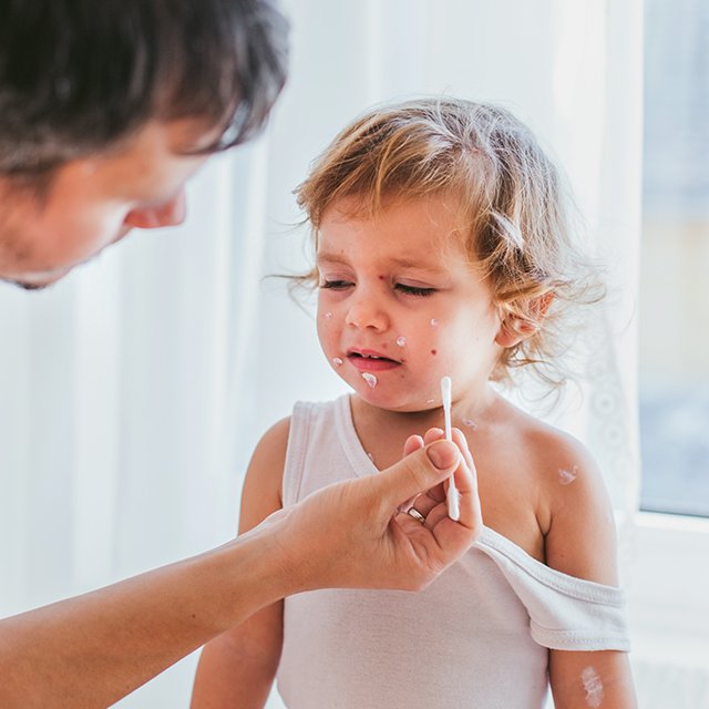 Сыпь при ветрянке, Коксаки и крапивнице: как их различить и чем помочь ребёнку