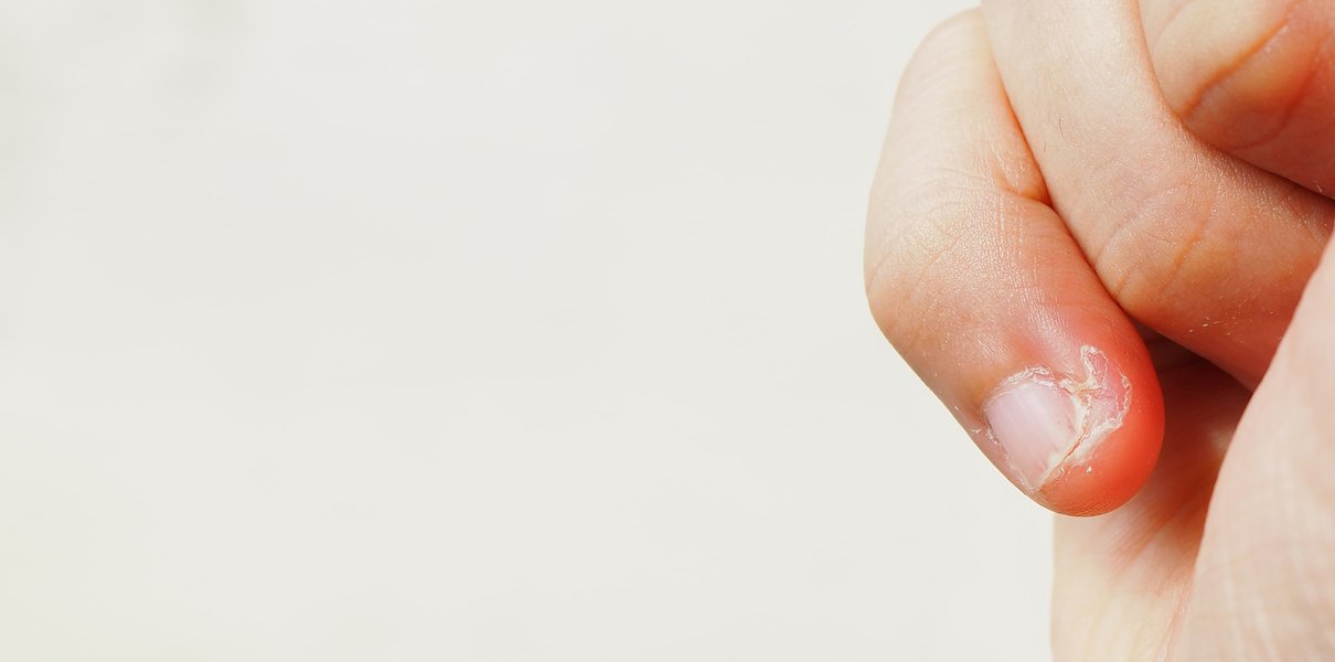 Кусание ногтей (онихофагия). Как перестать грызть ногти?