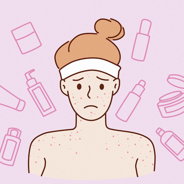 «Однажды прыщ лопнул во время поцелуя»: подростки – о жизни и борьбе с тяжелым акне