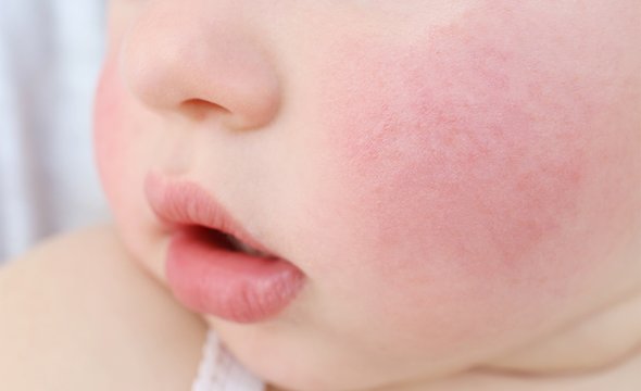 Аллергия на холод: как преодолеть неприятный недуг?