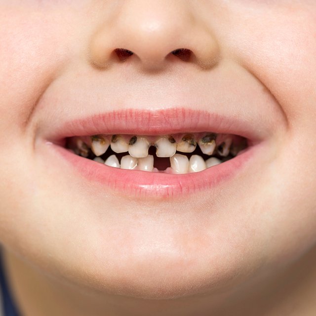 У ребёнка почернели зубы: в чём причина и что теперь делать