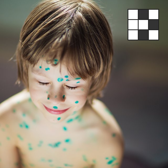 Если ребёнок весь в зелёнке, то у него... что? Кроссворд про детские болезни