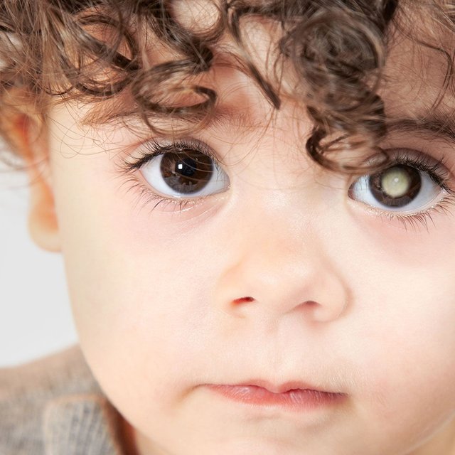 Как фото со вспышкой может указать на проблемы со зрением: памятка для родителей