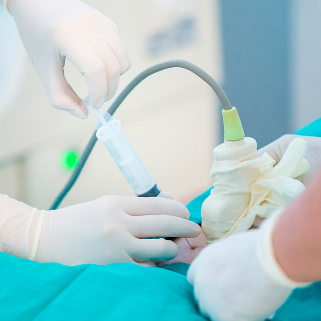 Что такое забор околоплодных вод у беременной, зачем он нужен и не опасно ли это