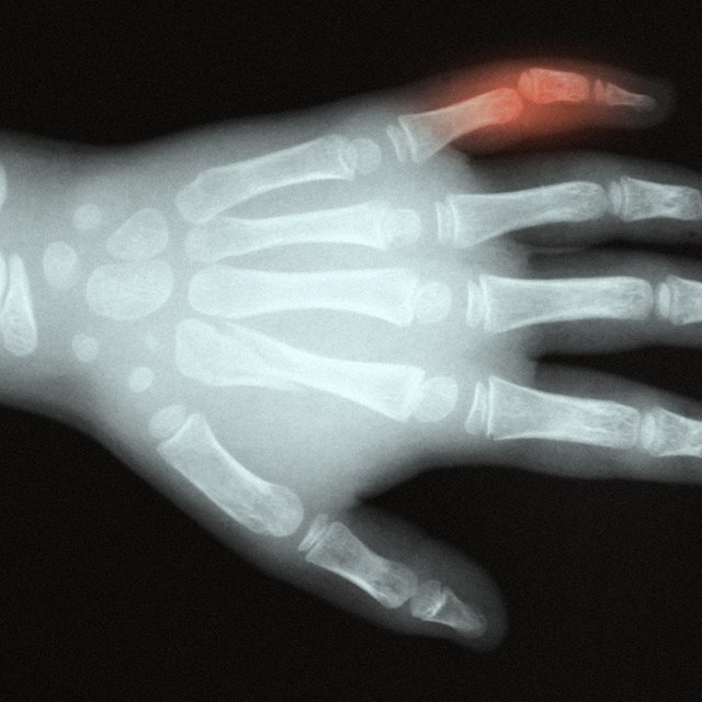 На физкультуре ученик случайно сломал палец однокласснице. Имеют ли право родители пострадавшей подать в суд?