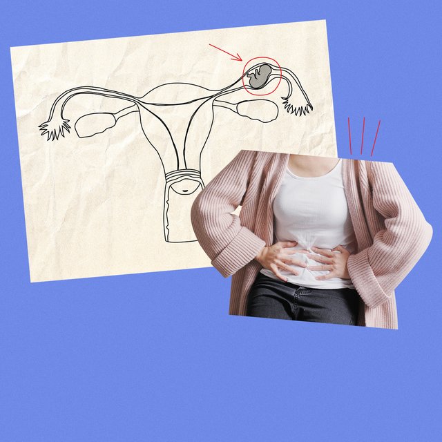 9 вопросов о внематочной беременности: что это, почему случается и можно ли потом иметь детей