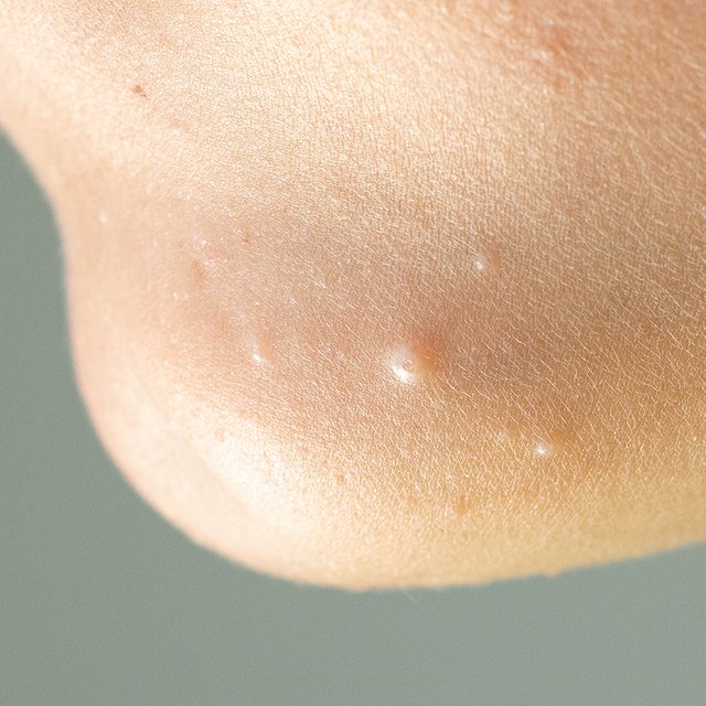 «А травки помогут?». Что такое контагиозный моллюск у детей и как его лечить