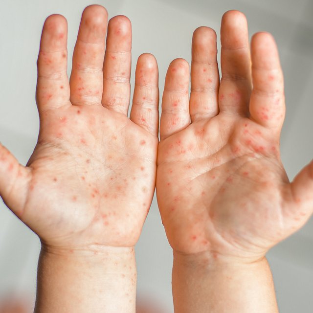 Вирус Коксаки: насколько он опасен и можно ли от него защититься