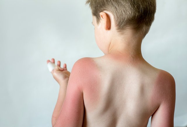 Ребёнок обгорел на солнце: как ему помочь и нужна ли сметана