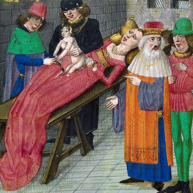 Переодетая в мужчину женщина и банановое вино: неожиданные факты о кесаревом сечении