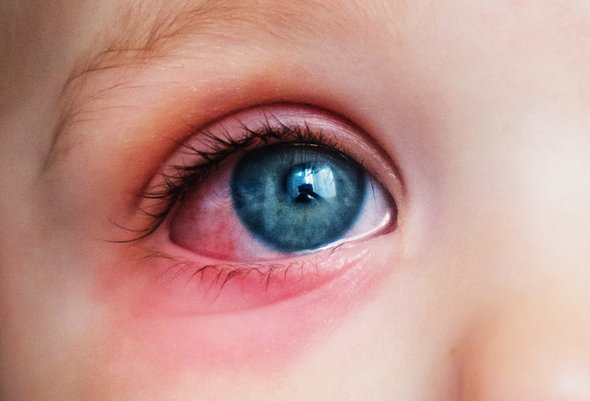 Красные глаза у ребенка. Синдром сухого глаза. Вирусный, бактериальный, аллергический конъюнктивит