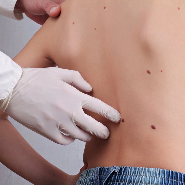 Ребёнок травмировал родинку: опасно ли это и что делать