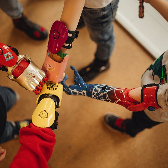 «Фея забыла наколдовать пальчики». Как устроено детское протезирование в России