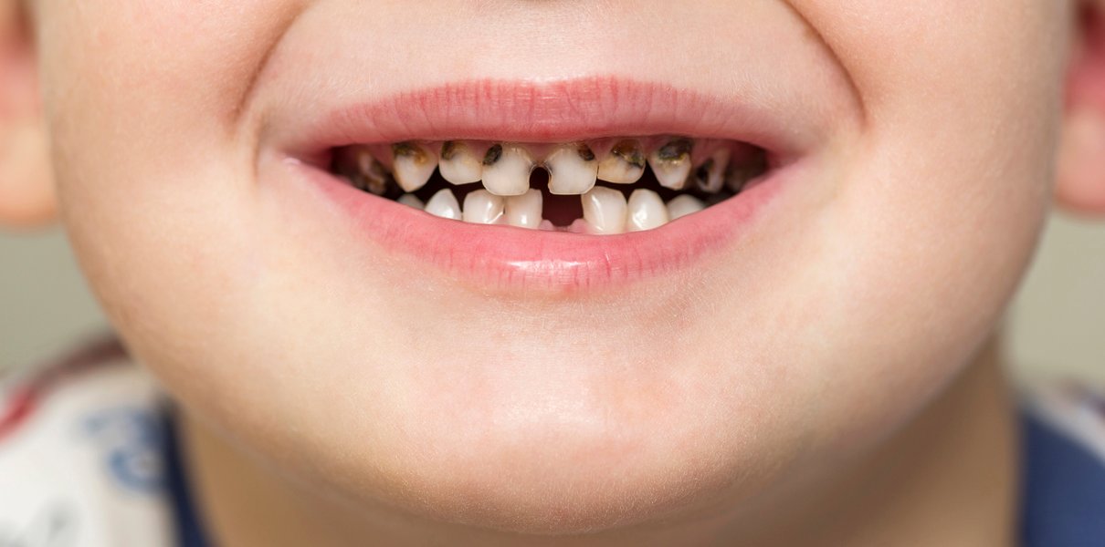 Черные зубы у детей - Причины ти лечение в S’Dental