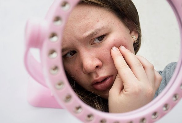 Как отучить давить прыщи