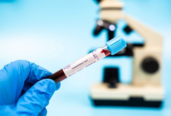 латентный железодефицит, как обнаружить, железо, анализы