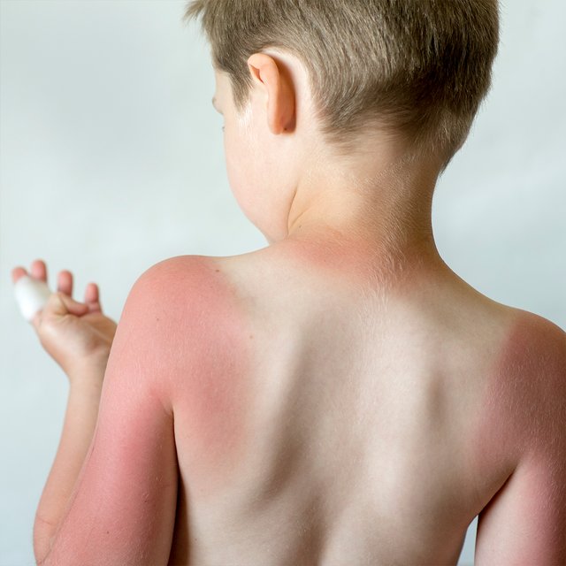 Ребёнок обгорел на солнце: как ему помочь и нужна ли сметана