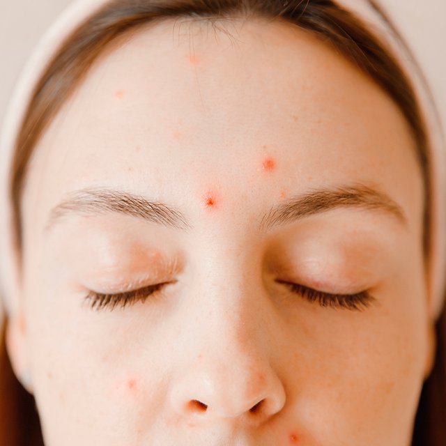 Ветрянка во время беременности: как не заразиться и что делать, если это произошло