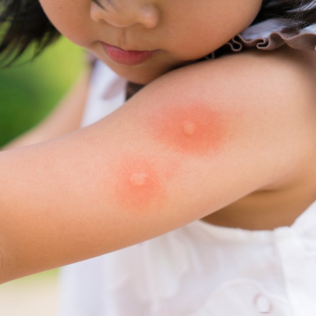 Ребёнка укусил комар и, кажется, начинается аллергическая реакция — как быть