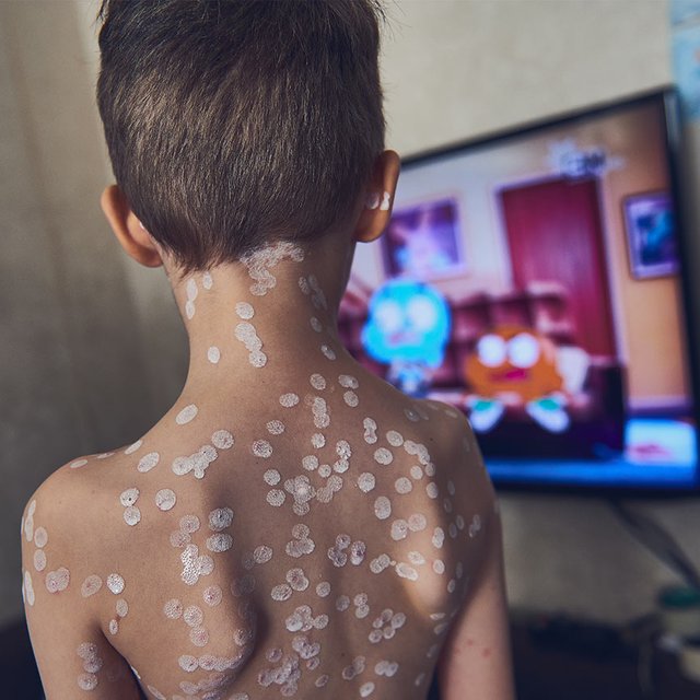 Резкий рост заболеваемости ветрянкой: что известно о ситуации и когда появится российская вакцина