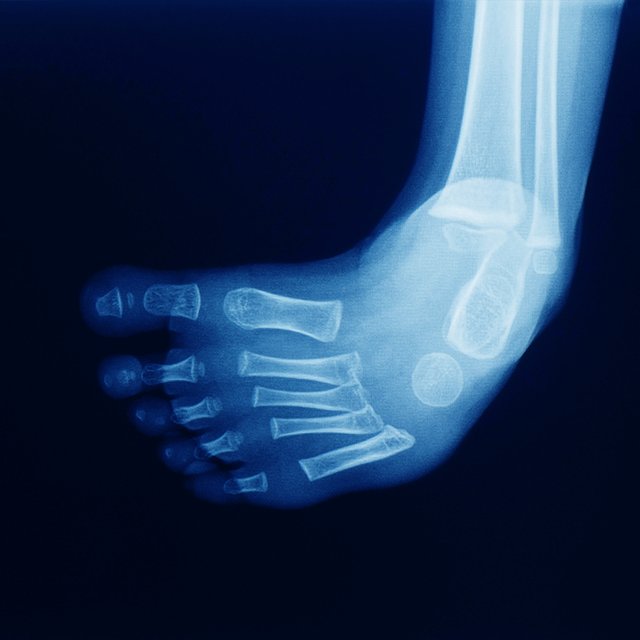 Ребёнок косолапит. Можно ли исправить проблему и как это сделать