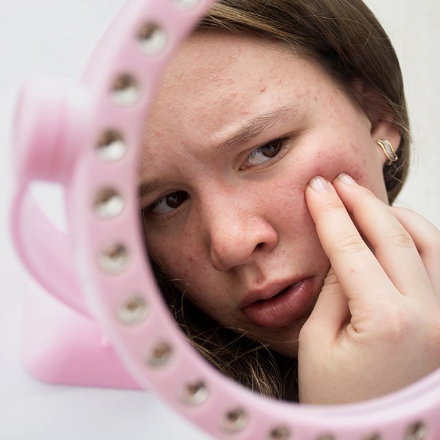 Что делать, если подросток постоянно давит прыщи?